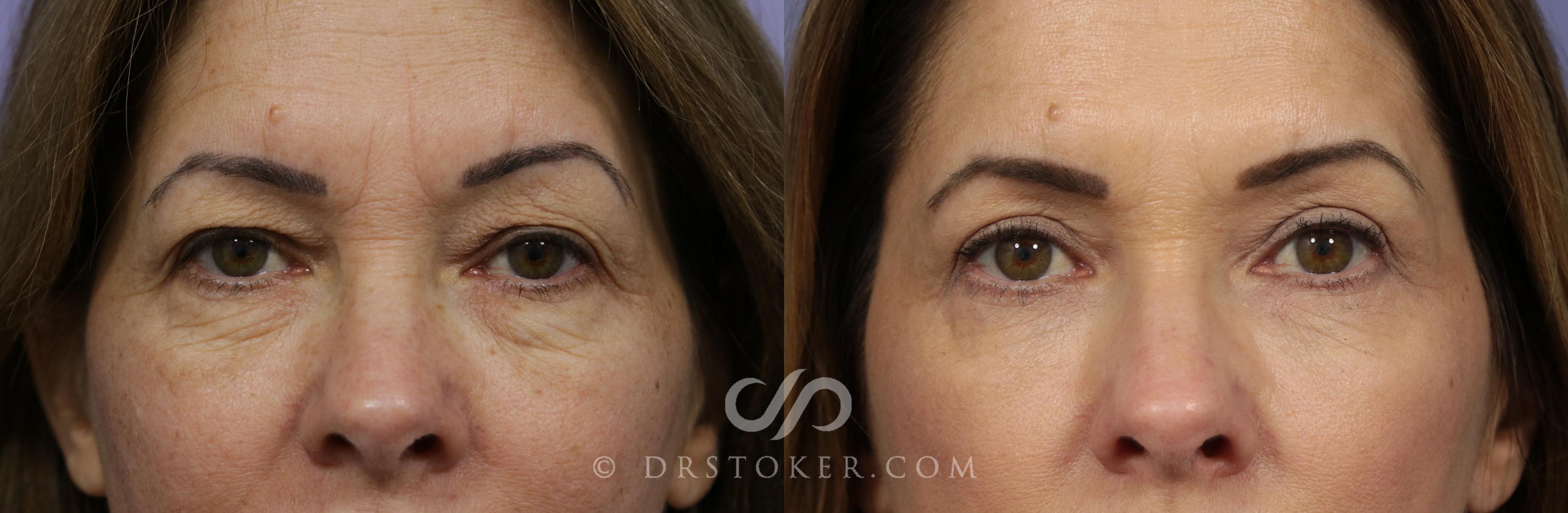 Before & After Laser Resurfacing  Case 929 View #1 View in Marina del Rey, CA