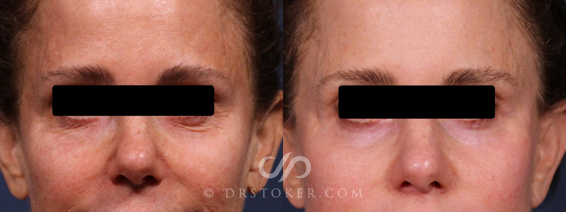 Before & After Laser Skin Resurfacing Eyes Case 2377 Front View in Los Angeles, CA
