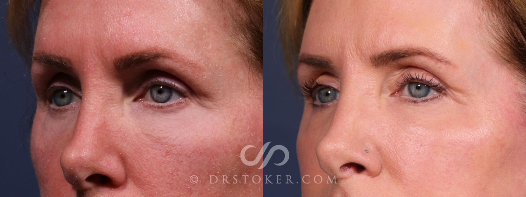 Before & After Laser Skin Resurfacing Eyes Case 2602 Left Oblique View in Los Angeles, CA