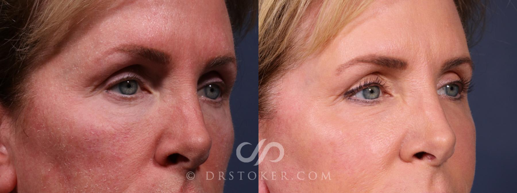 Before & After Laser Skin Resurfacing Eyes Case 2602 Right Oblique View in Los Angeles, CA