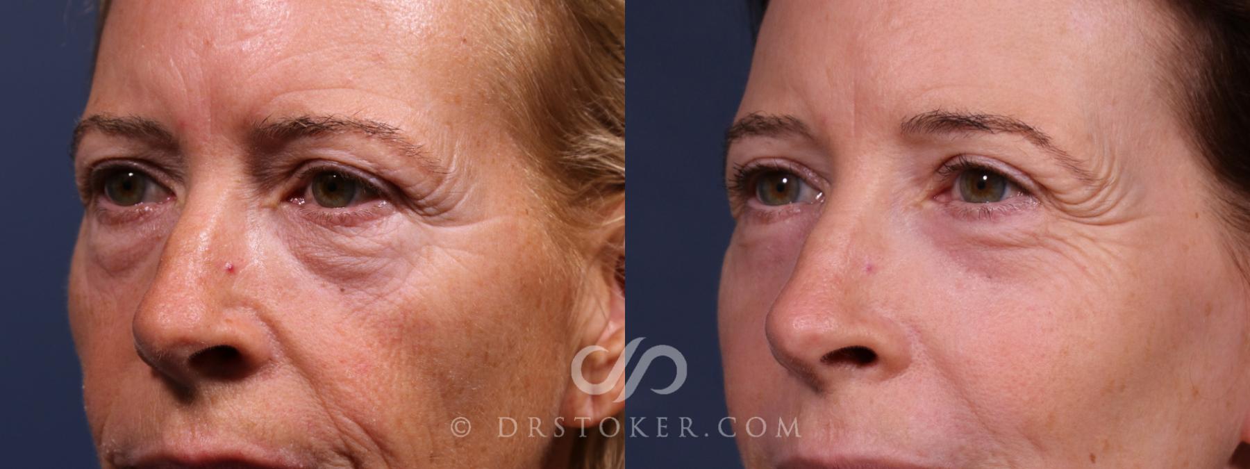 Before & After Laser Skin Resurfacing Eyes Case 2638 Left Oblique View in Los Angeles, CA