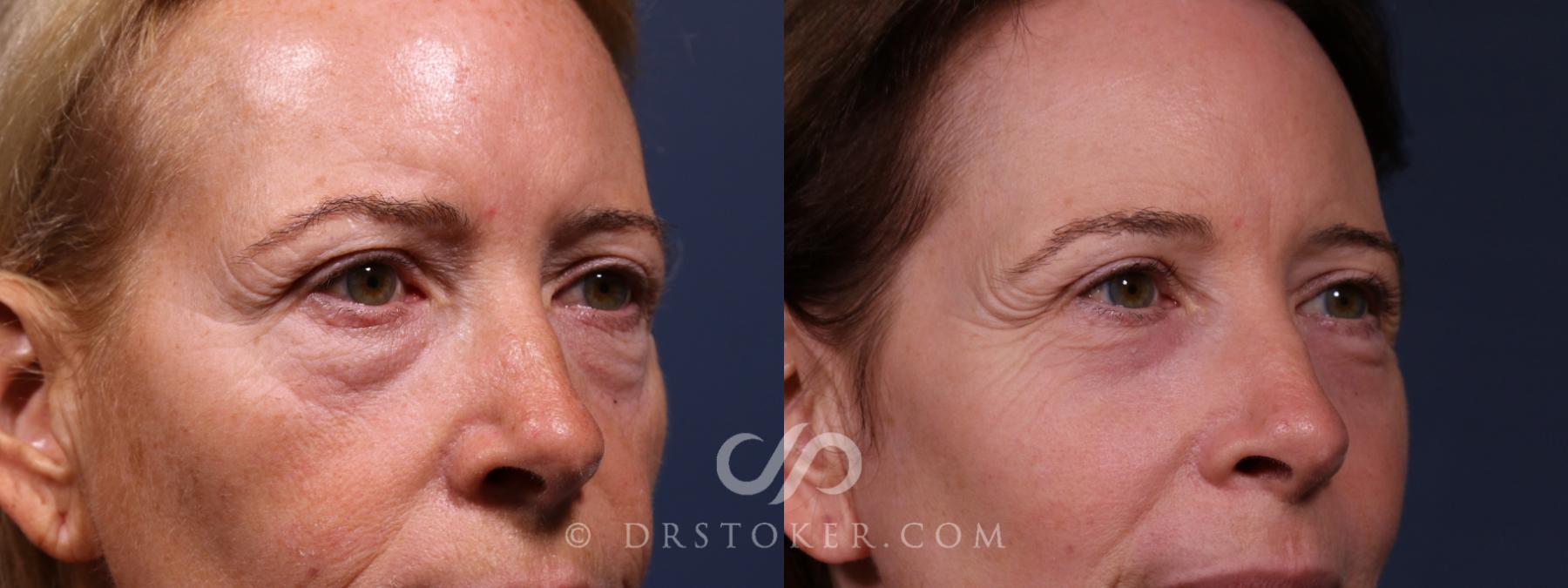 Before & After Laser Skin Resurfacing Eyes Case 2638 Right Oblique View in Los Angeles, CA