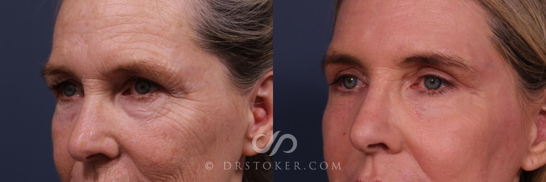 Before & After Laser Skin Resurfacing Eyes Case 2667 Left Oblique View in Los Angeles, CA