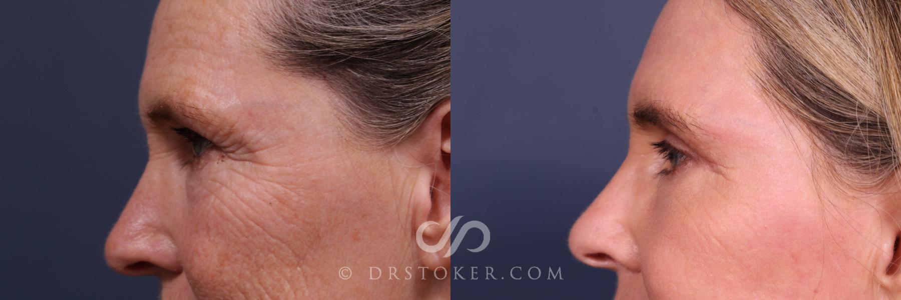 Before & After Laser Skin Resurfacing Eyes Case 2667 Left Side View in Los Angeles, CA