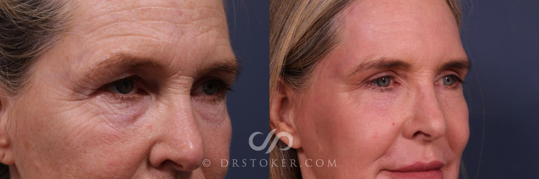 Before & After Laser Skin Resurfacing Eyes Case 2667 Right Oblique View in Los Angeles, CA