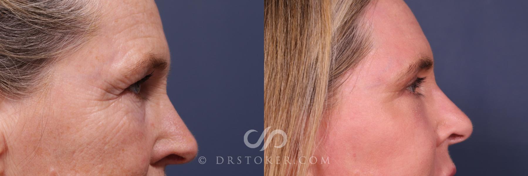 Before & After Laser Skin Resurfacing Eyes Case 2667 Right Side View in Los Angeles, CA