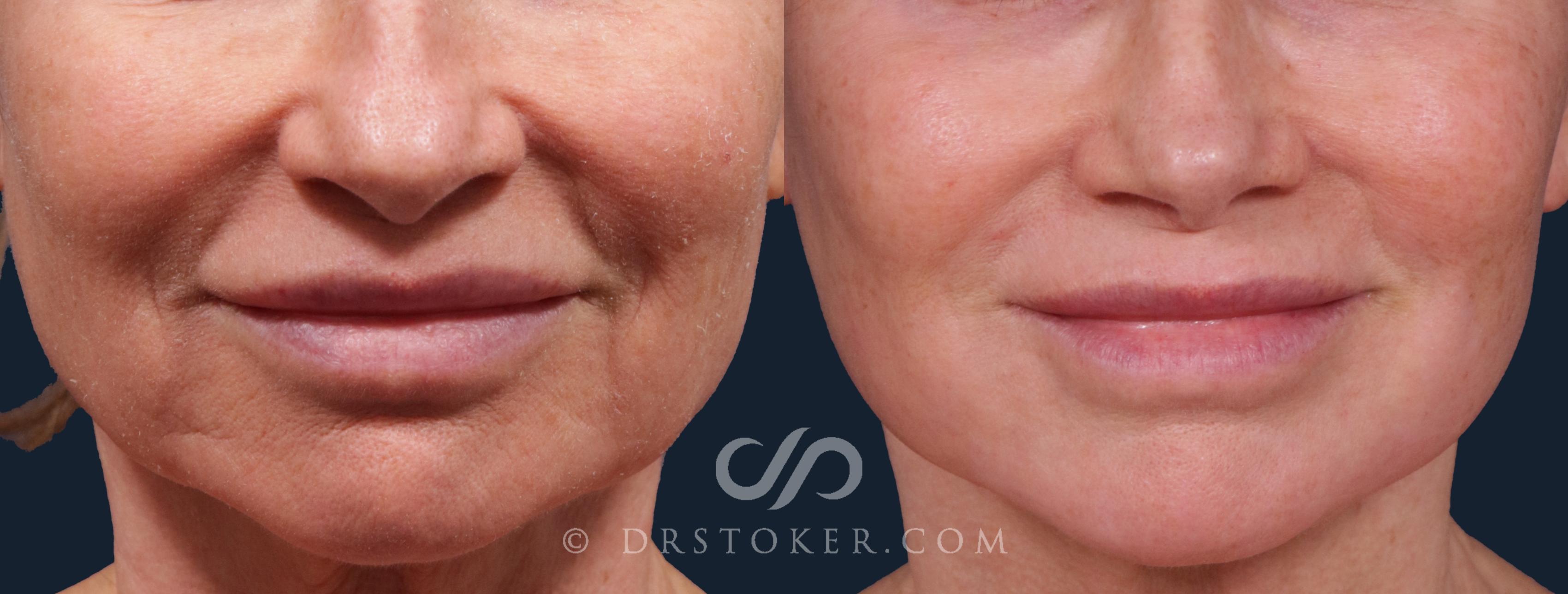 Before & After Laser Skin Resurfacing Case 2226 Front View in Los Angeles, CA