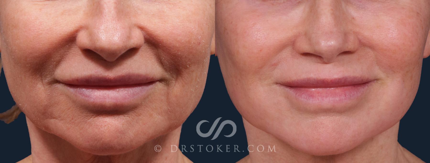 Before & After Laser Skin Resurfacing Case 2226 Front View in Los Angeles, CA