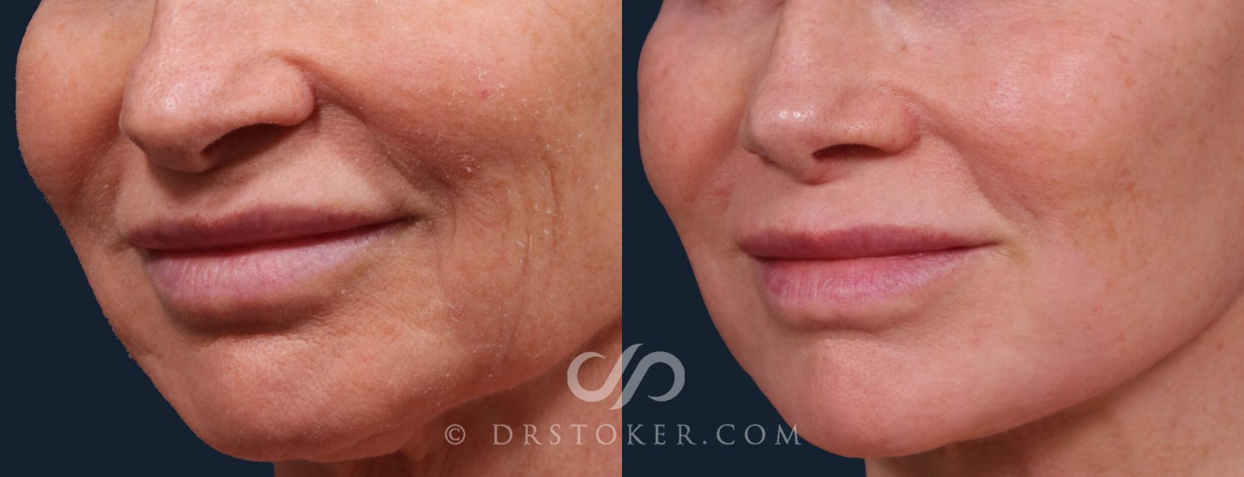 Before & After Laser Skin Resurfacing (Mouth) Case 2226 Left Oblique View in Los Angeles, CA