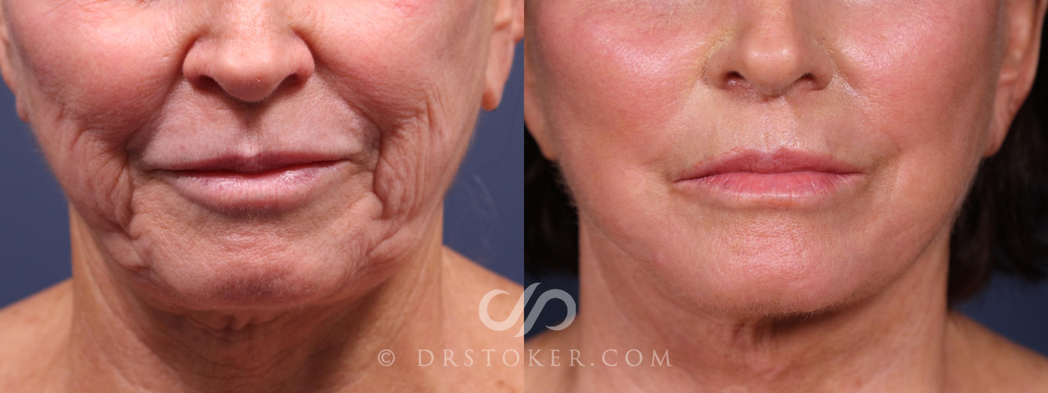 Before & After Laser Skin Resurfacing (Mouth) Case 2344 Front View in Los Angeles, CA