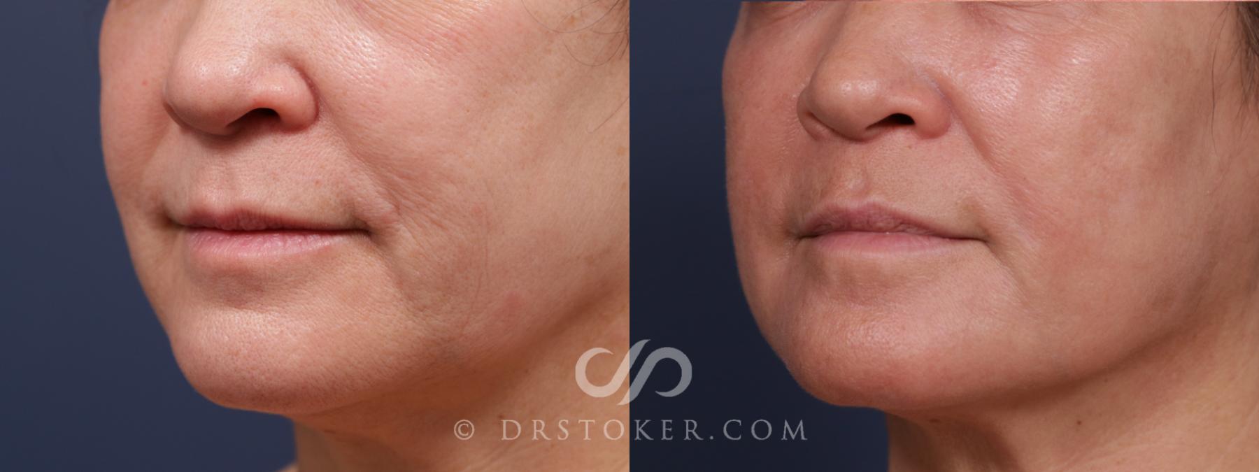 Before & After Laser Skin Resurfacing (Mouth) Case 2572 Left Oblique View in Los Angeles, CA