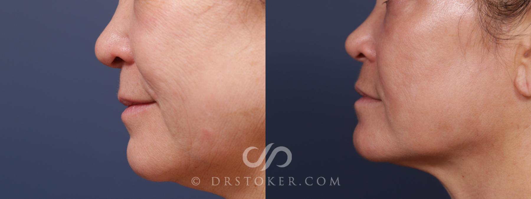 Before & After Laser Skin Resurfacing (Mouth) Case 2572 Left Side View in Los Angeles, CA