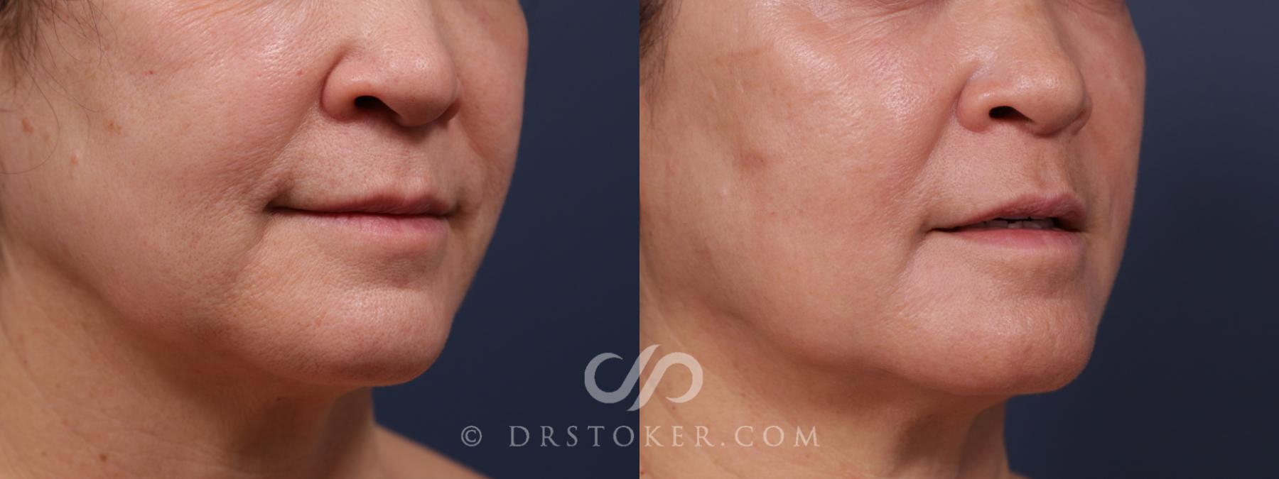 Before & After Laser Skin Resurfacing (Mouth) Case 2572 Right Oblique View in Los Angeles, CA
