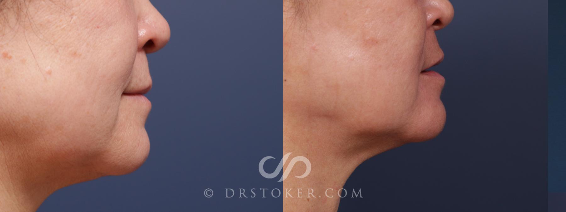 Before & After Laser Skin Resurfacing (Mouth) Case 2572 Right Side View in Los Angeles, CA
