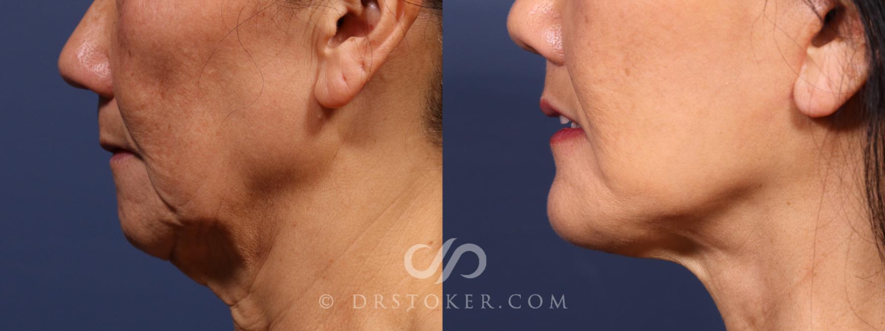 Before & After Laser Skin Resurfacing (Mouth) Case 2622 Left Side View in Los Angeles, CA