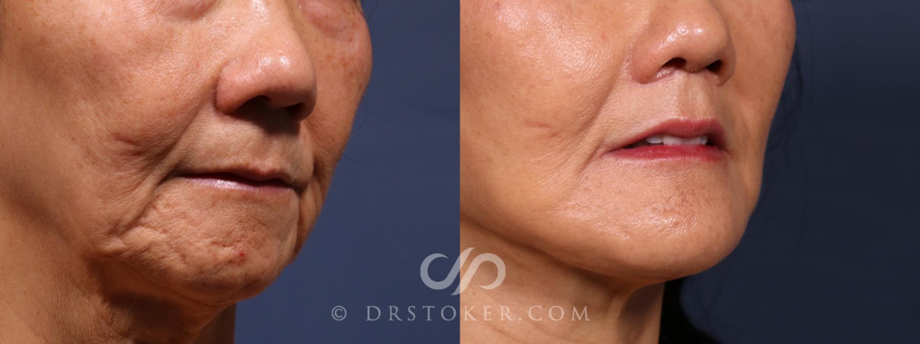 Before & After Laser Skin Resurfacing (Mouth) Case 2622 Right Oblique View in Los Angeles, CA