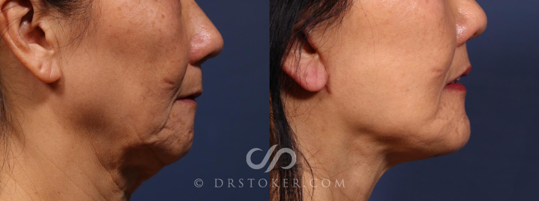 Before & After Laser Skin Resurfacing (Mouth) Case 2622 Right Side View in Los Angeles, CA