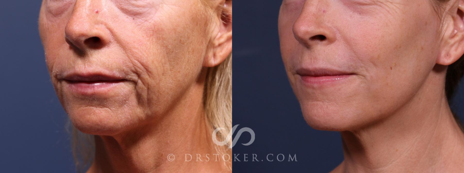 Before & After Laser Skin Resurfacing (Mouth) Case 2639 Left Oblique View in Los Angeles, CA