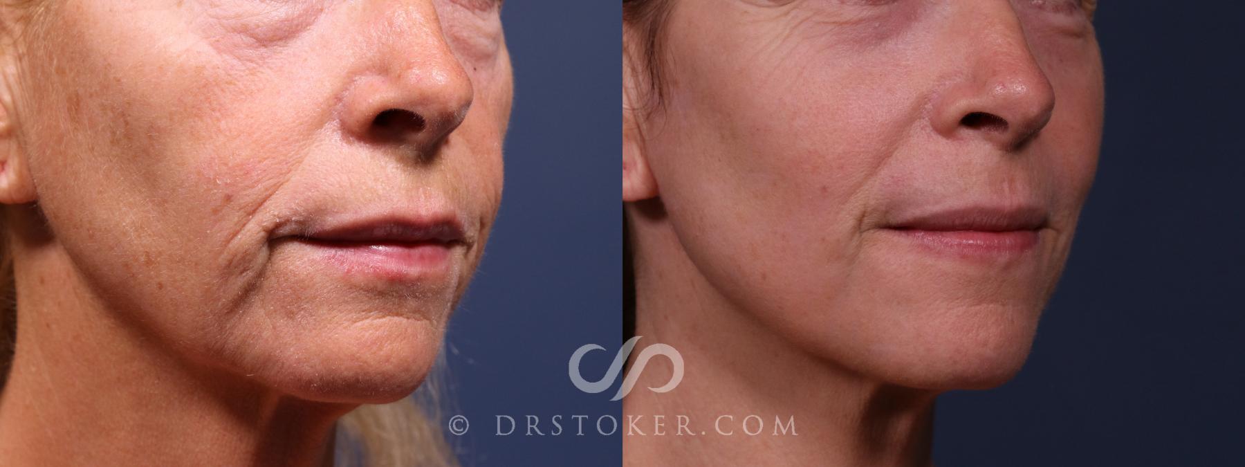 Before & After Laser Skin Resurfacing (Mouth) Case 2639 Right Oblique View in Los Angeles, CA
