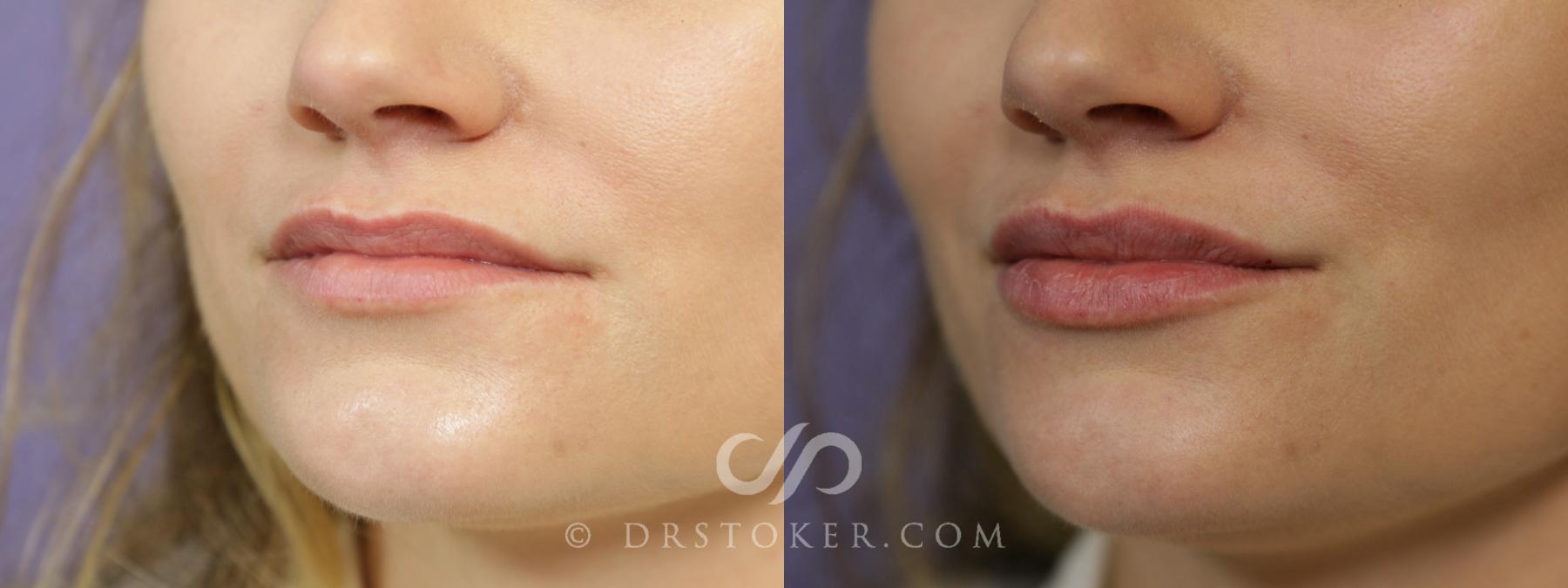 Before & After Lip Fillers/Augmentation Case 1582 View #1 View in Los Angeles, CA