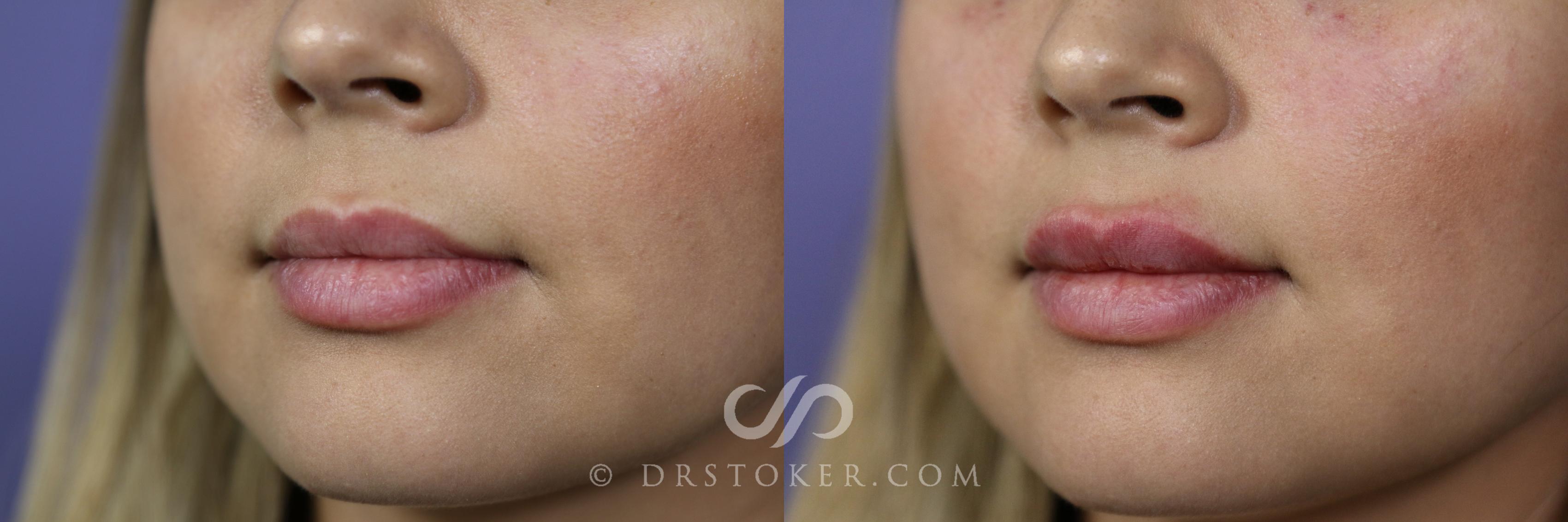 Before & After Lip Fillers/Augmentation Case 1600 View #1 View in Los Angeles, CA