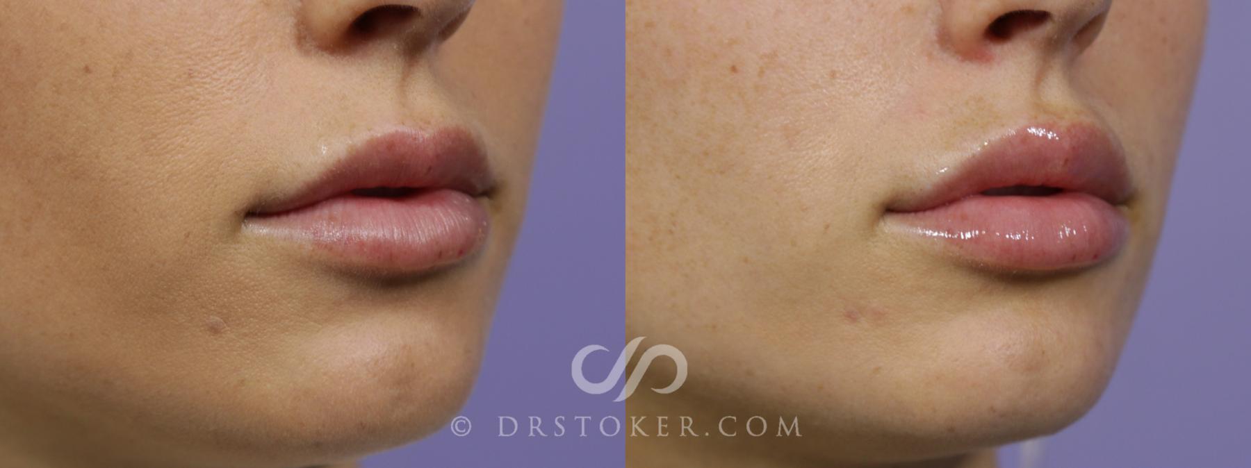 Before & After Lip Fillers/Augmentation Case 1601 View #1 View in Los Angeles, CA