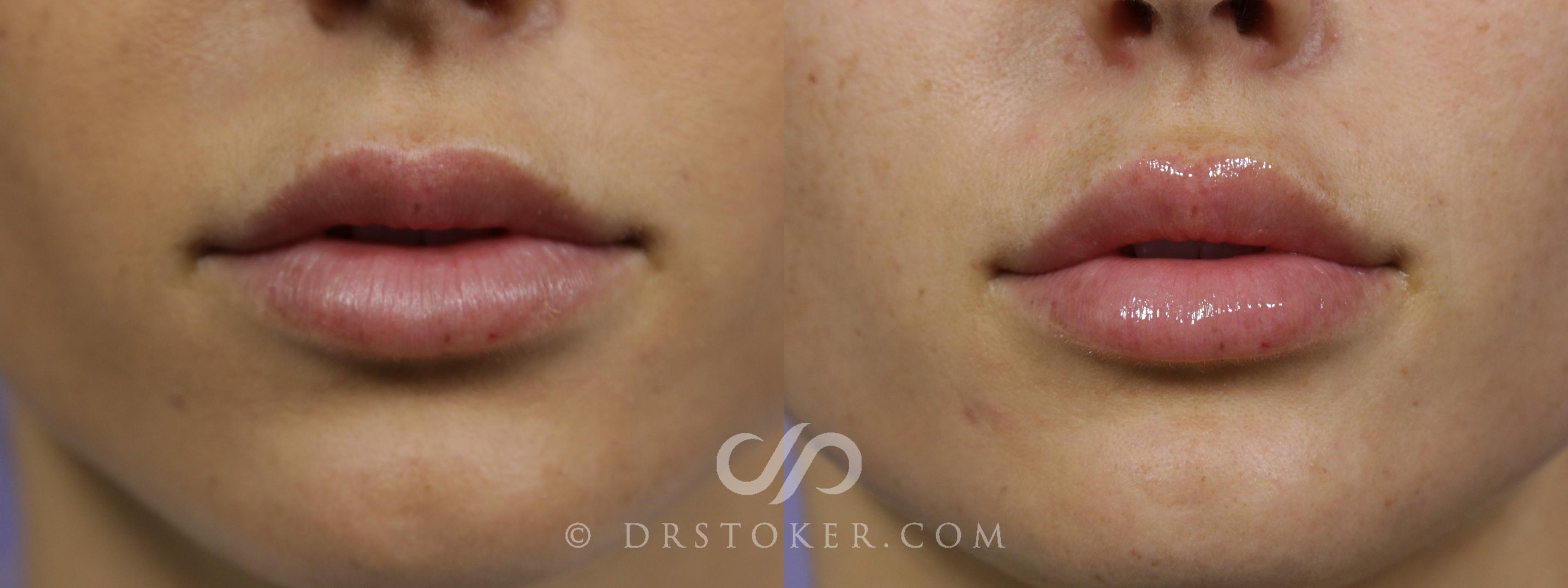 Before & After Lip Fillers/Augmentation Case 1601 View #2 View in Los Angeles, CA