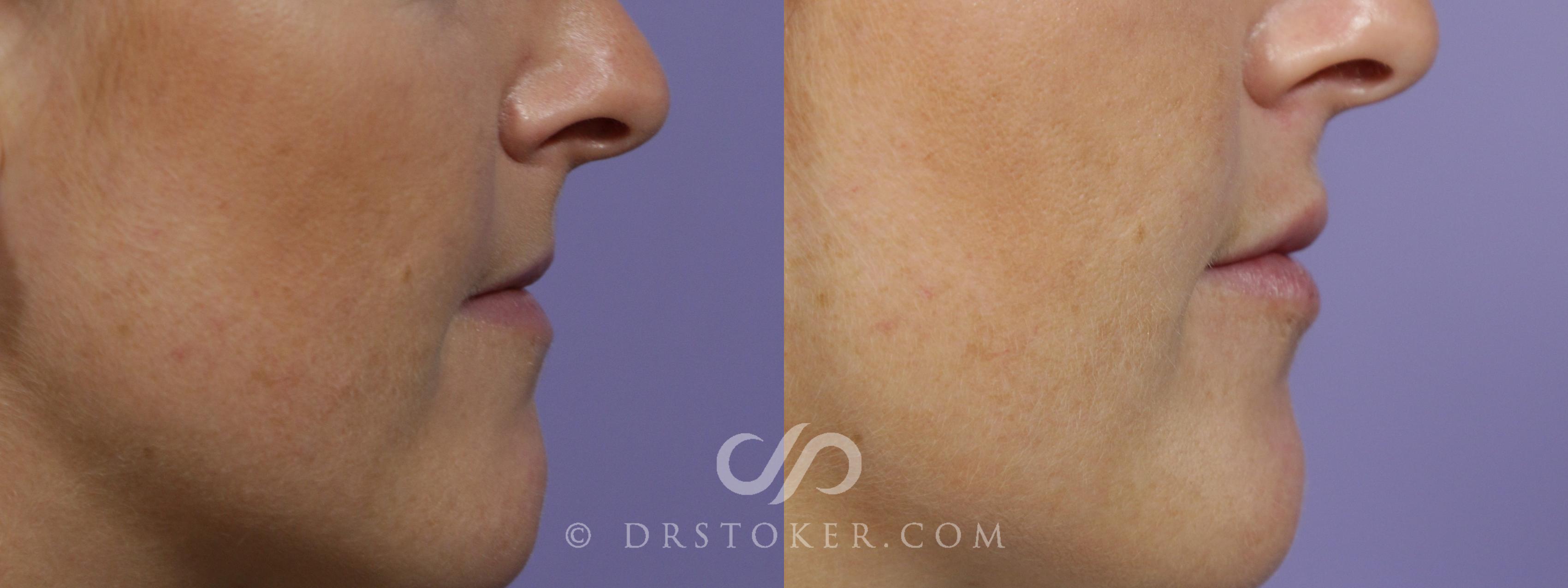 Before & After Lip Fillers/Augmentation Case 1602 View #1 View in Los Angeles, CA