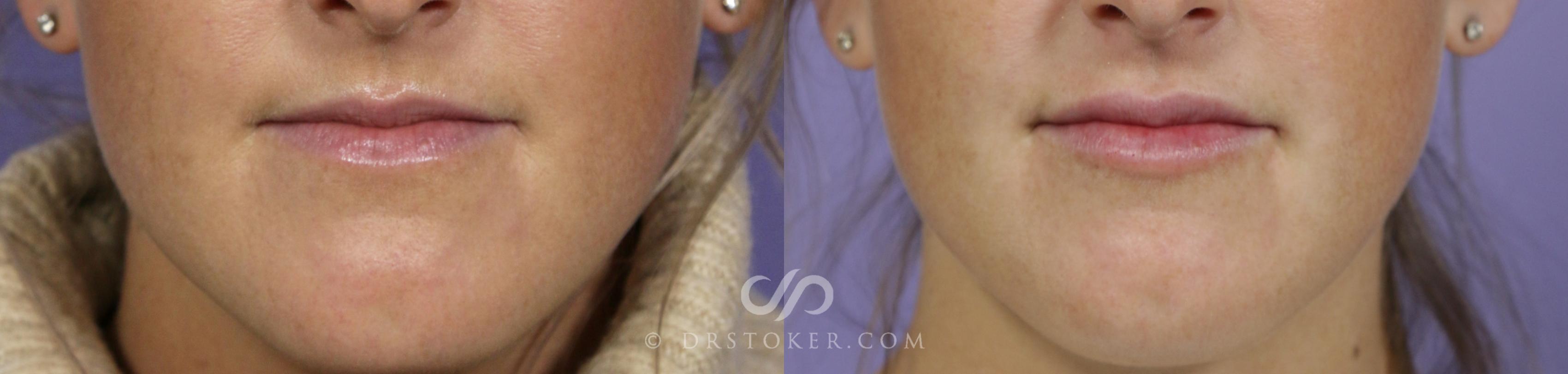 Before & After Lip Fillers/Augmentation Case 1602 View #2 View in Los Angeles, CA