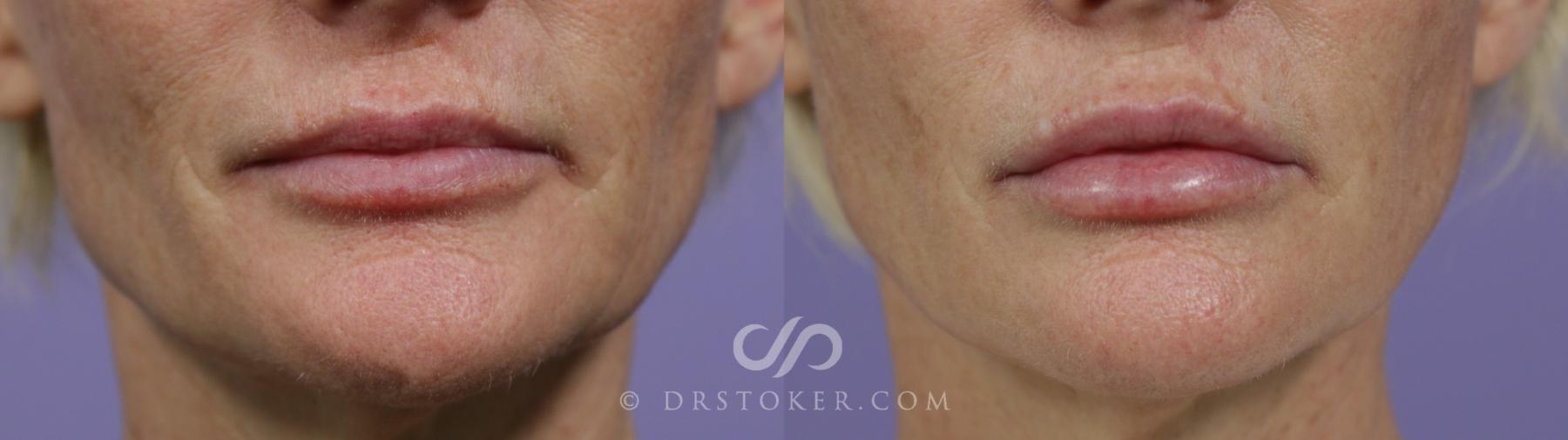 Before & After Lip Fillers/Augmentation Case 1606 View #1 View in Los Angeles, CA