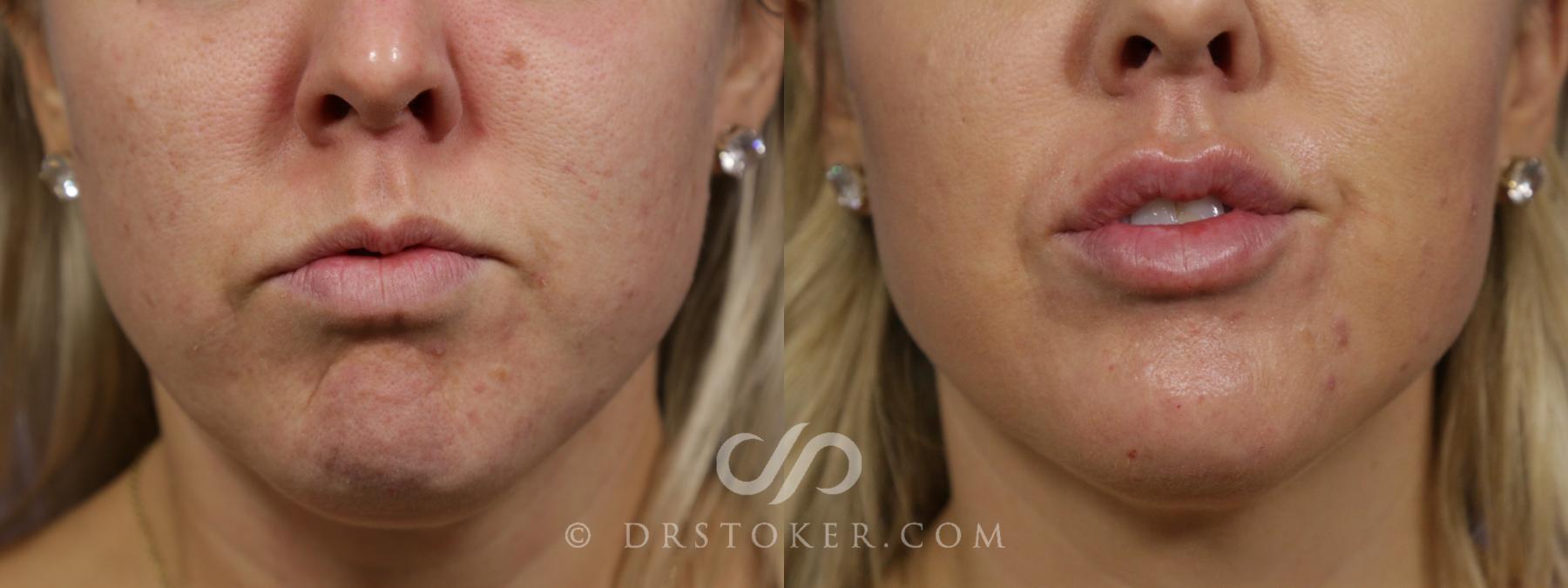 Before & After BOTOX®, Dysport®, & Jeuveau® Case 1654 View #1 View in Los Angeles, CA