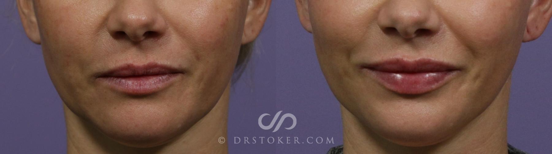 Before & After Lip Fillers/Augmentation Case 1854 Front View in Los Angeles, CA
