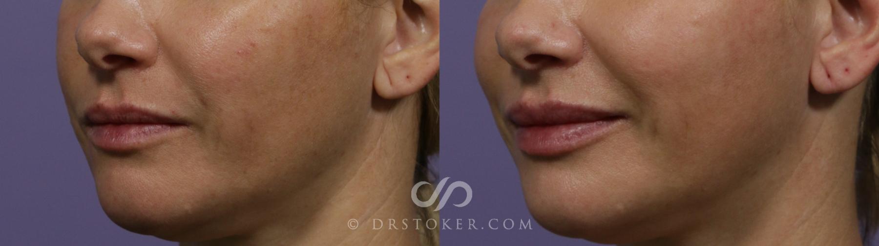 Before & After Lip Fillers/Augmentation Case 1854 Left Oblique View in Los Angeles, CA