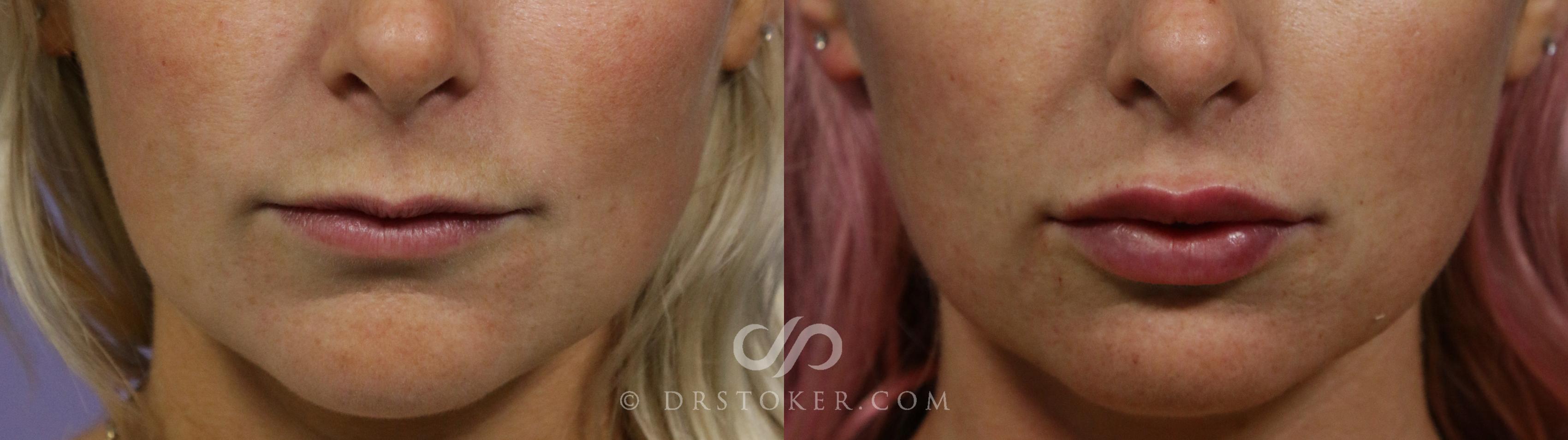 Before & After Lip Fillers/Augmentation Case 1855 Front View in Los Angeles, CA