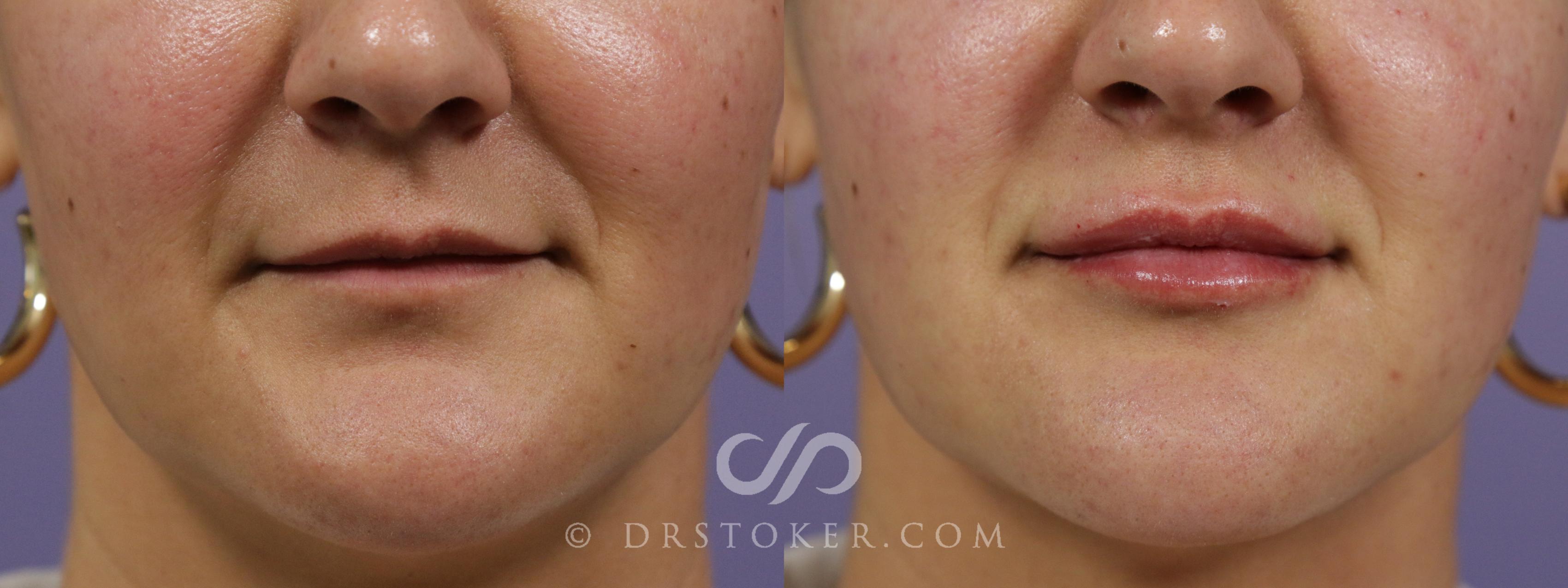 Before & After Lip Fillers/Augmentation Case 1858 Front View in Los Angeles, CA