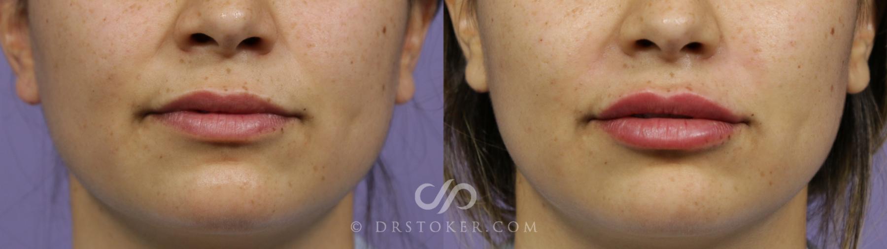 Before & After Lip Fillers/Augmentation Case 1863 Front View in Los Angeles, CA