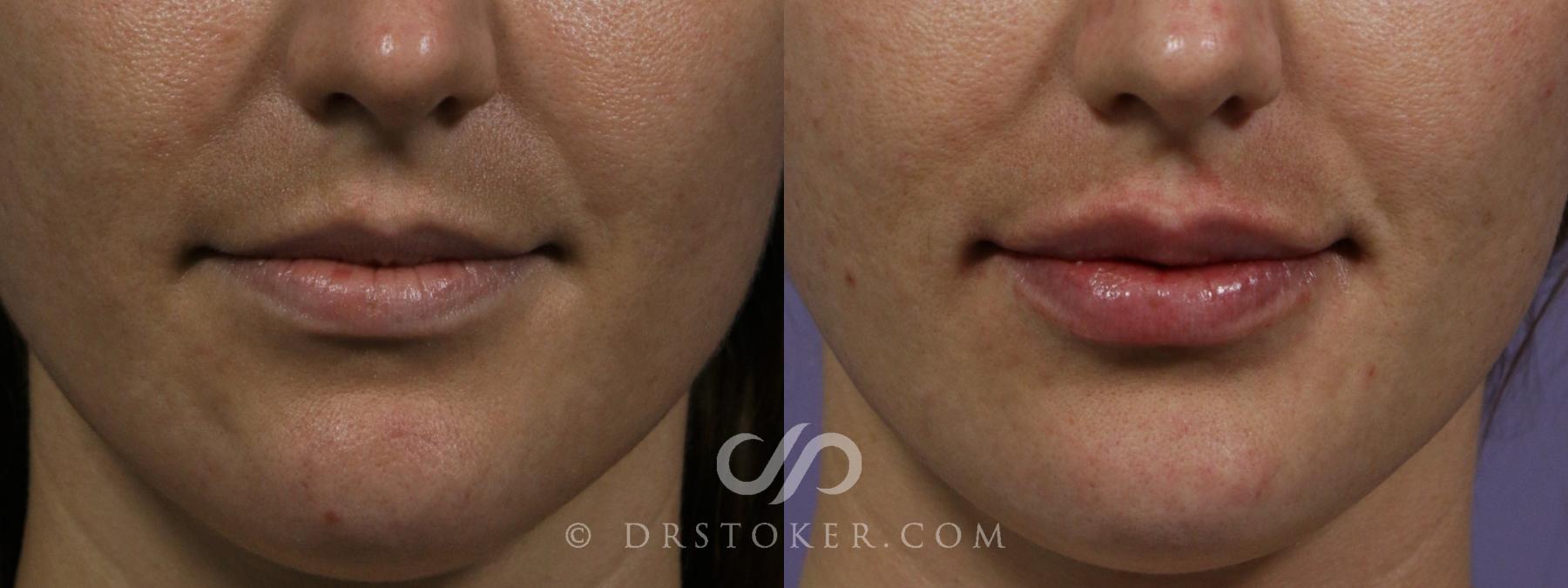 Before & After Lip Fillers/Augmentation Case 1868 Front View in Los Angeles, CA