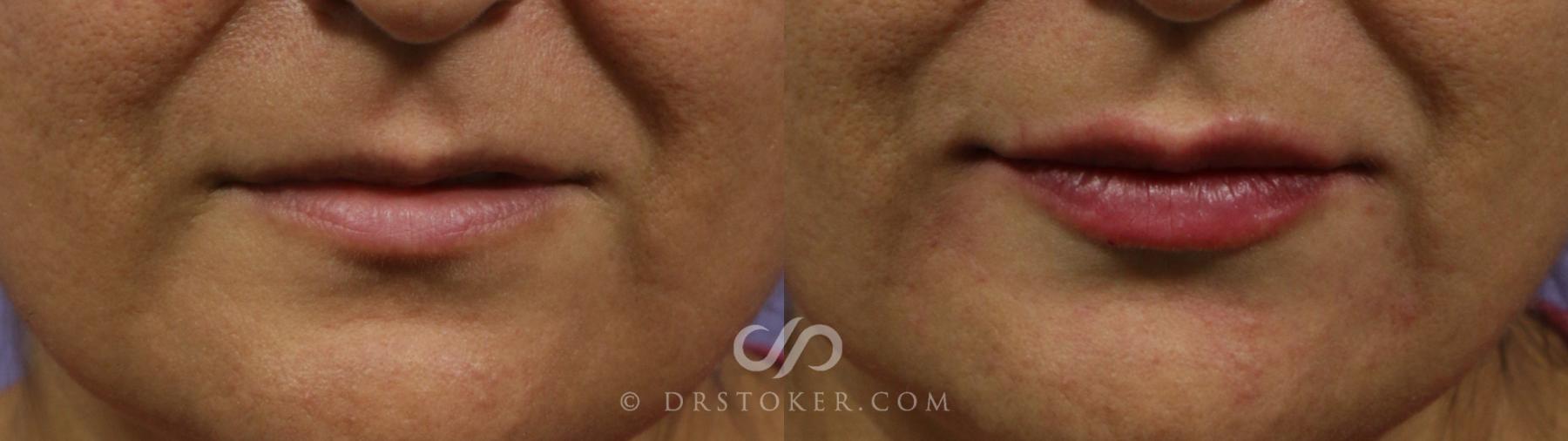 Before & After Lip Fillers/Augmentation Case 1869 Front View in Los Angeles, CA