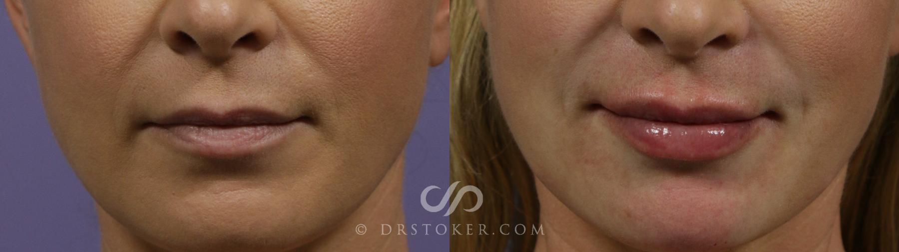 Before & After Lip Fillers/Augmentation Case 1872 Front View in Los Angeles, CA