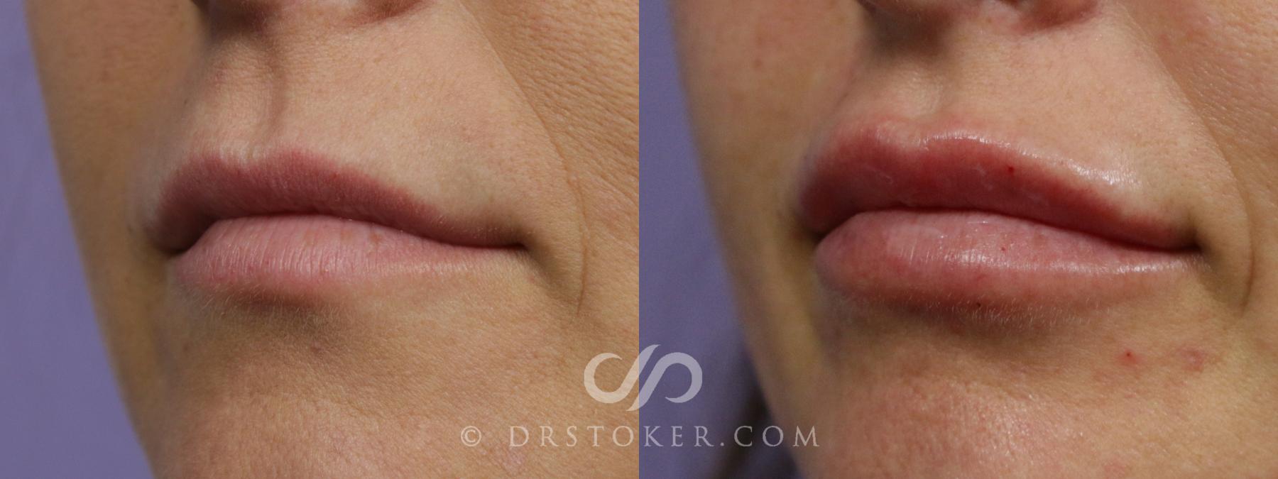 Before & After Lip Fillers/Augmentation Case 1881 Left Oblique View in Los Angeles, CA