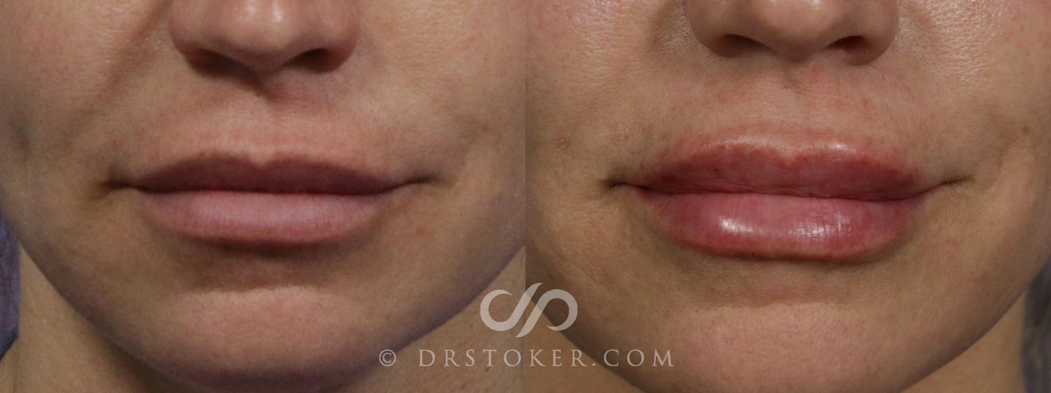 Before & After Lip Fillers/Augmentation Case 1882 Front View in Los Angeles, CA