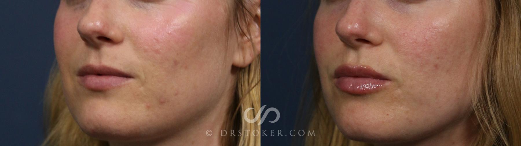 Before & After Lip Fillers/Augmentation Case 2293 Left Oblique View in Los Angeles, CA