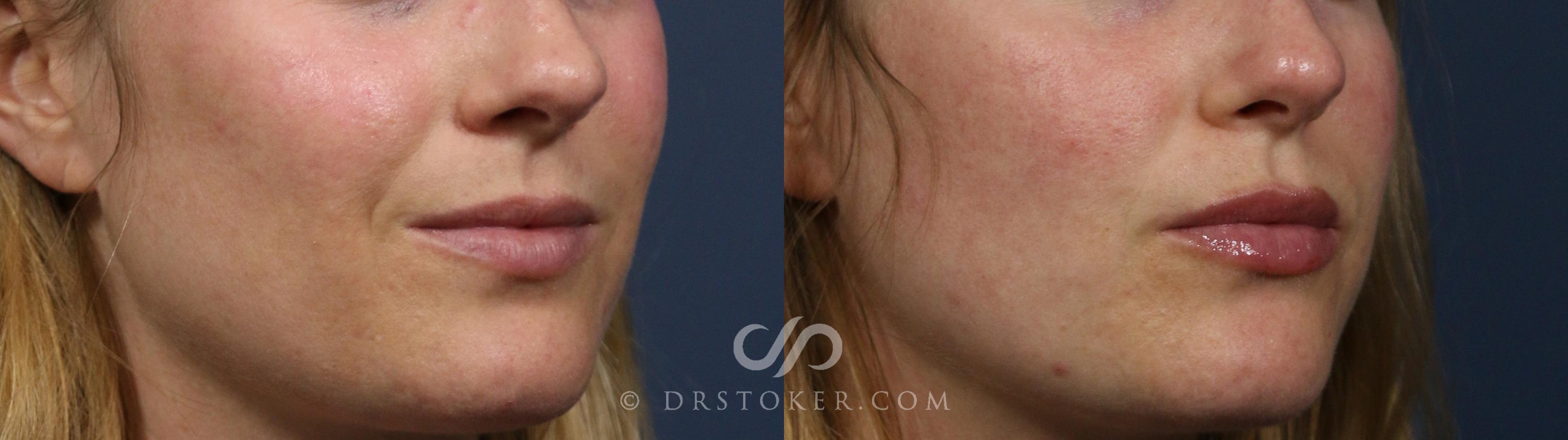 Before & After Lip Fillers/Augmentation Case 2294 Right Oblique View in Los Angeles, CA