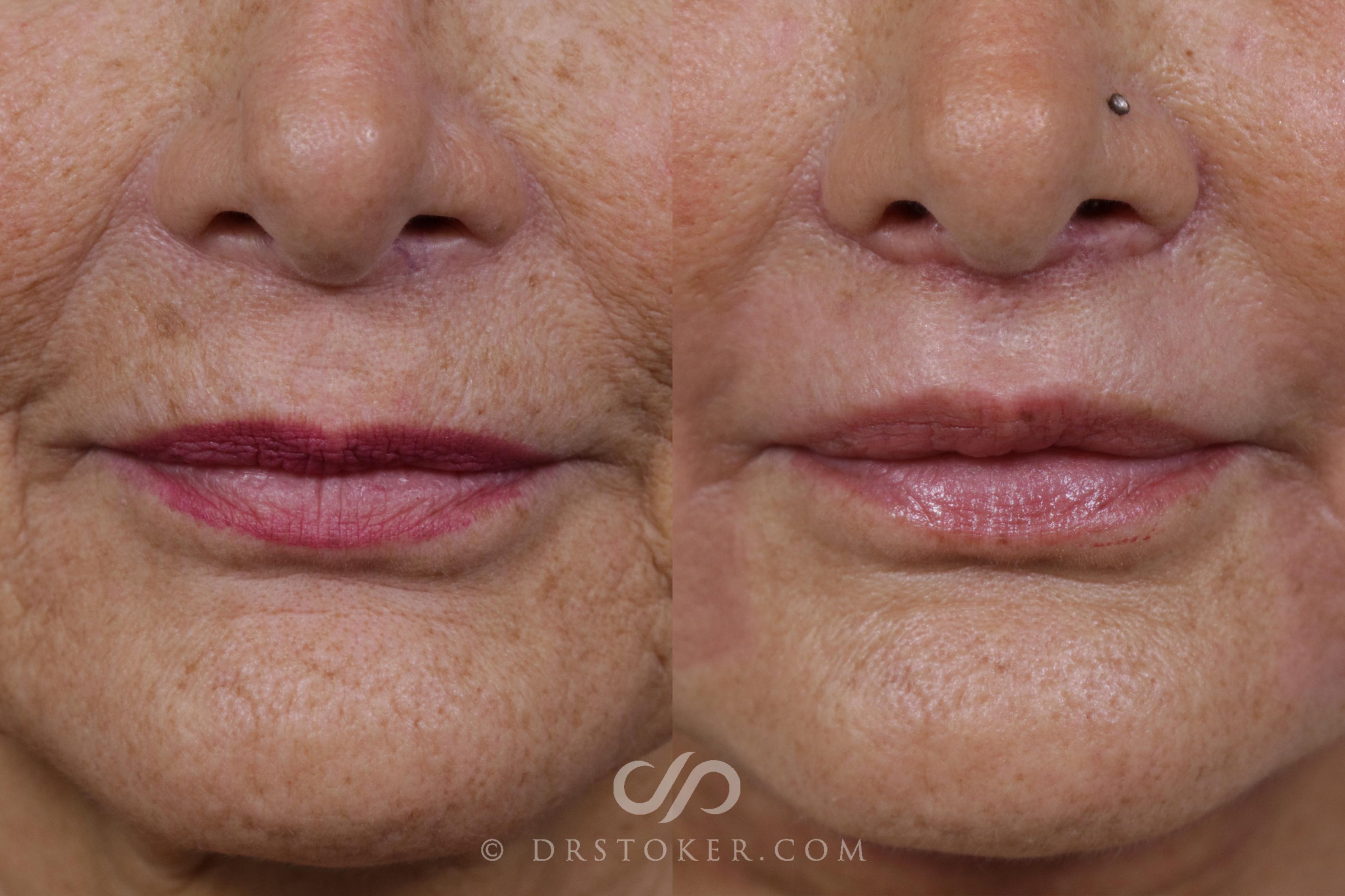 Before & After Laser Resurfacing Mouth Case 1670 View #1 View in Marina del Rey, CA