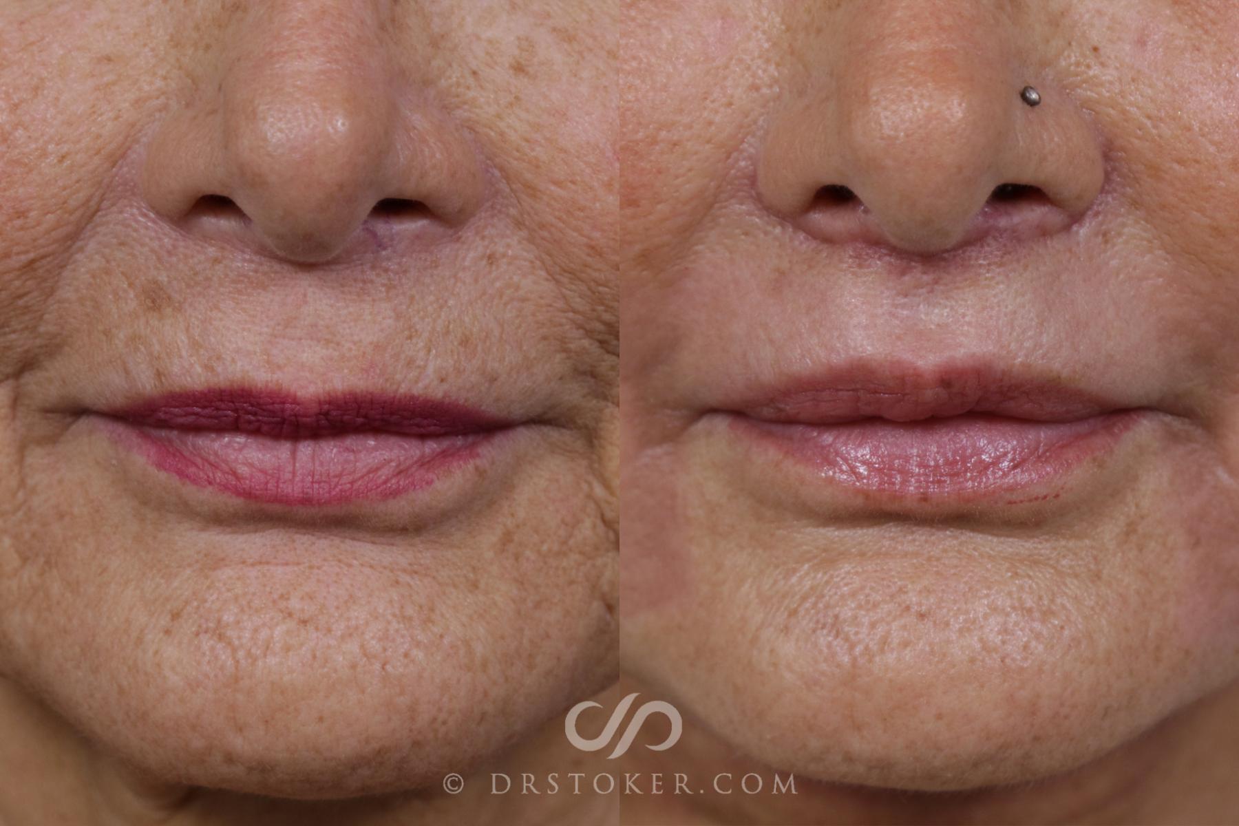 Before & After Lip Lift Case 1670 View #1 View in Los Angeles, CA