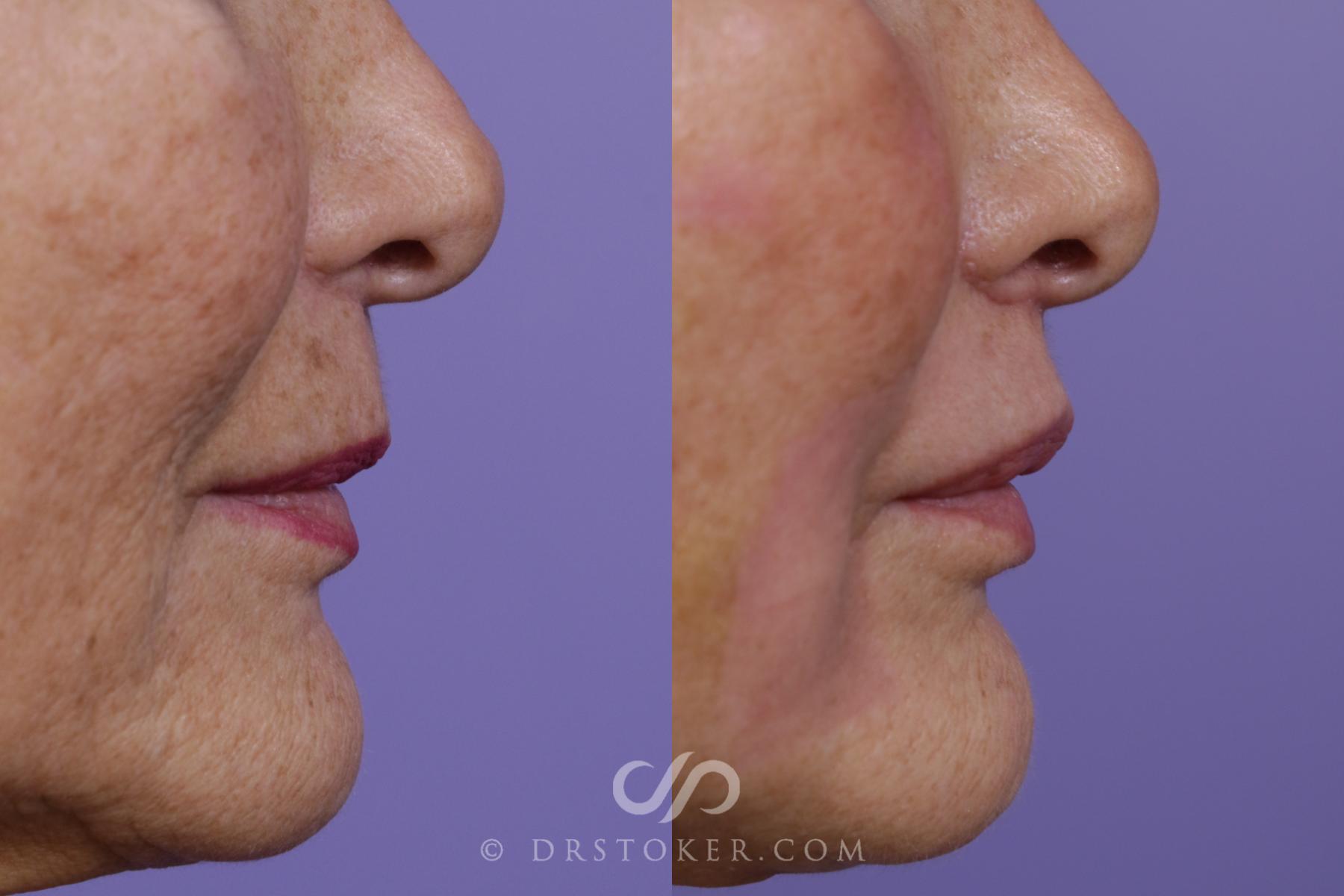 Before & After Laser Skin Resurfacing (Mouth) Case 1671 View #1 View in Los Angeles, CA