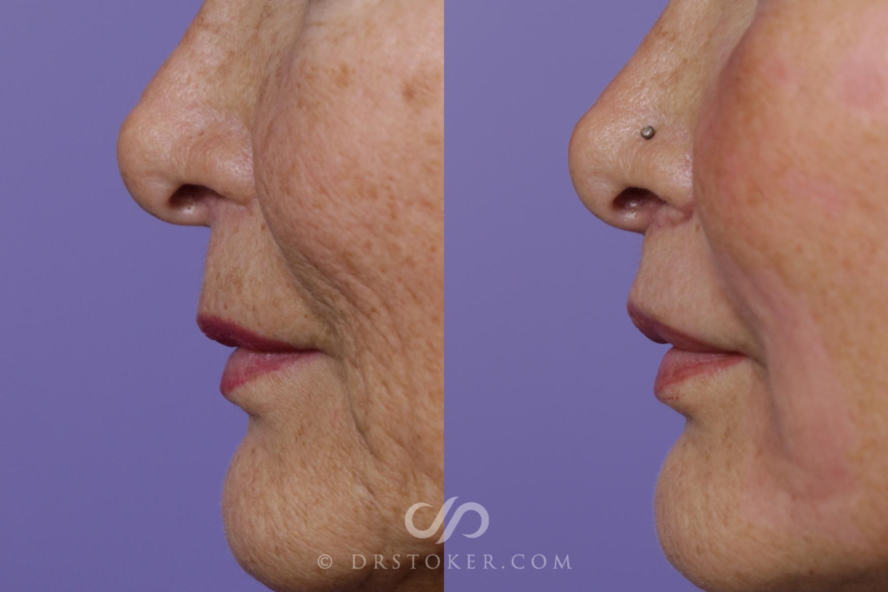 Before & After Laser Skin Resurfacing (Mouth) Case 1672 View #1 View in Los Angeles, CA