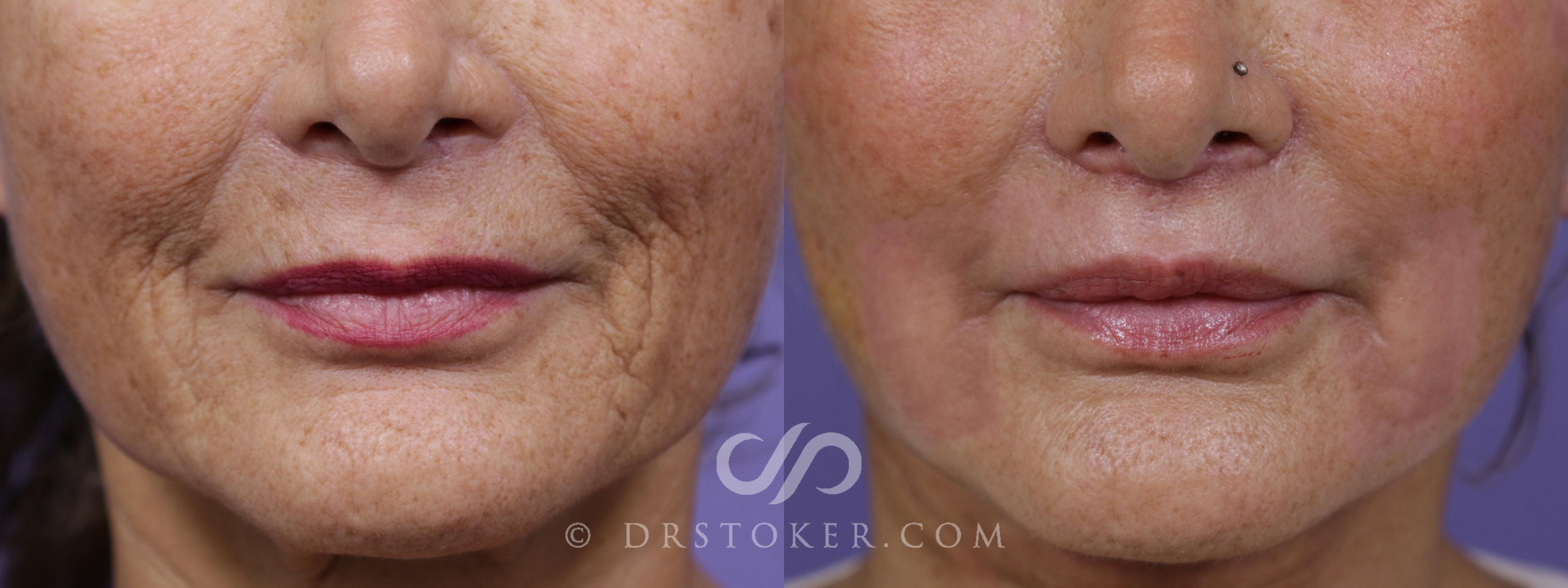 Before & After Laser Resurfacing Mouth Case 1673 View #1 View in Marina del Rey, CA