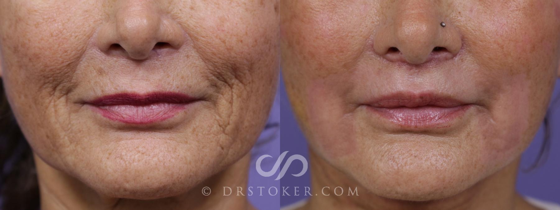 Before & After Lip Lift Case 1673 View #1 View in Los Angeles, CA