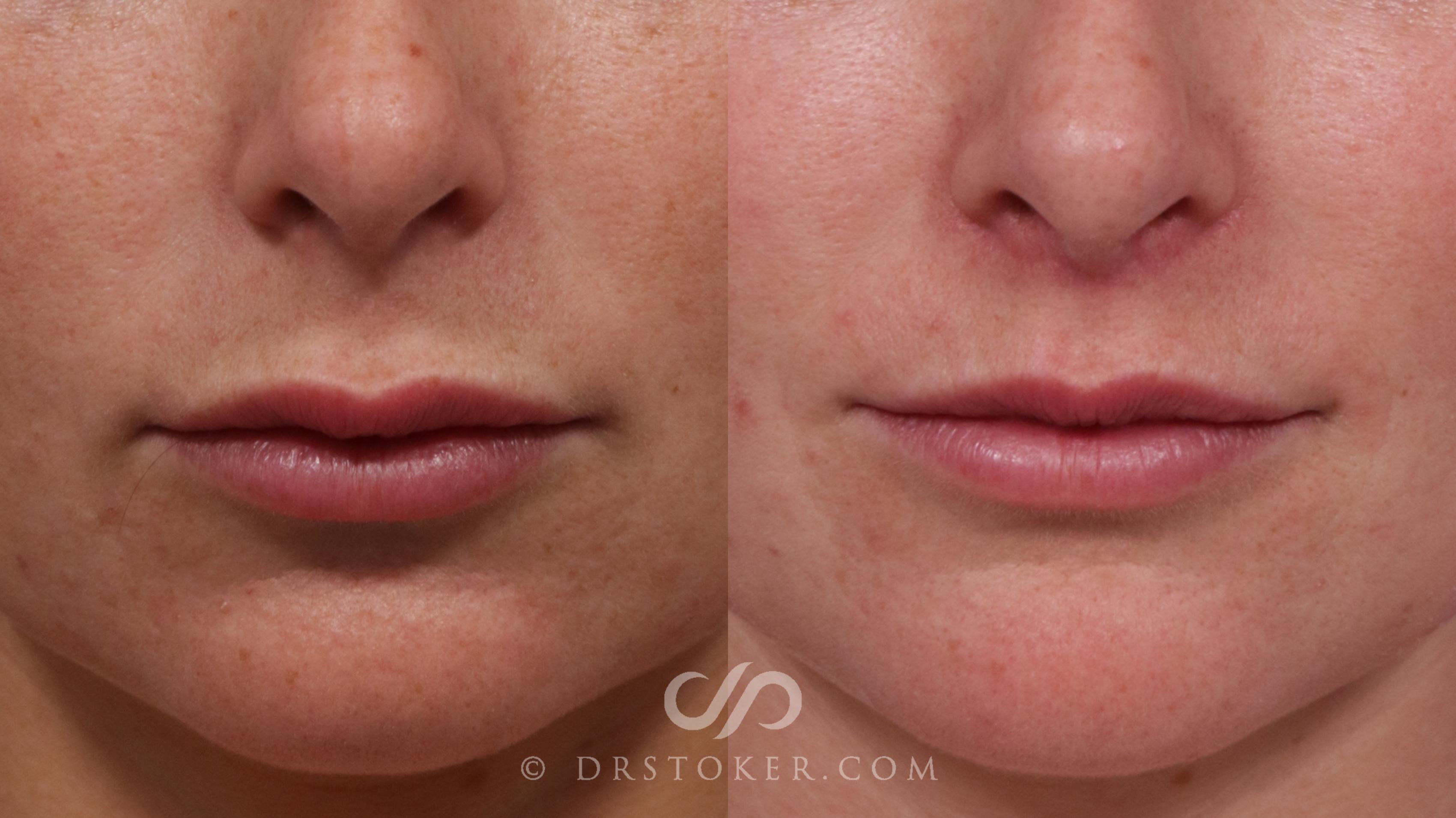Before & After Lip Lift Case 1802 Front View in Los Angeles, CA